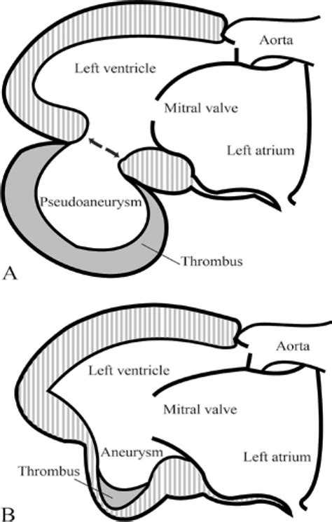 lv apical aneurysm vs pseudoaneurysm|pseudoaneurysm vs true aneurysm.